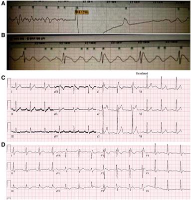 Case Report: Comprehensive evaluation of ECG phenotypes and genotypes in a family with Brugada syndrome carrying SCN5A-R376H